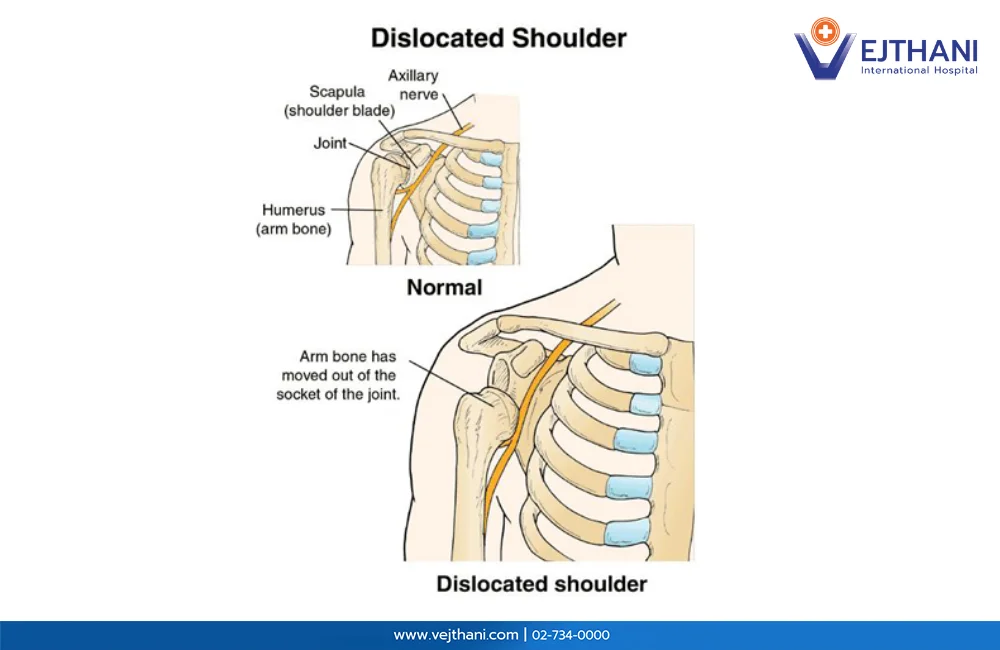 Dislocated Shoulder