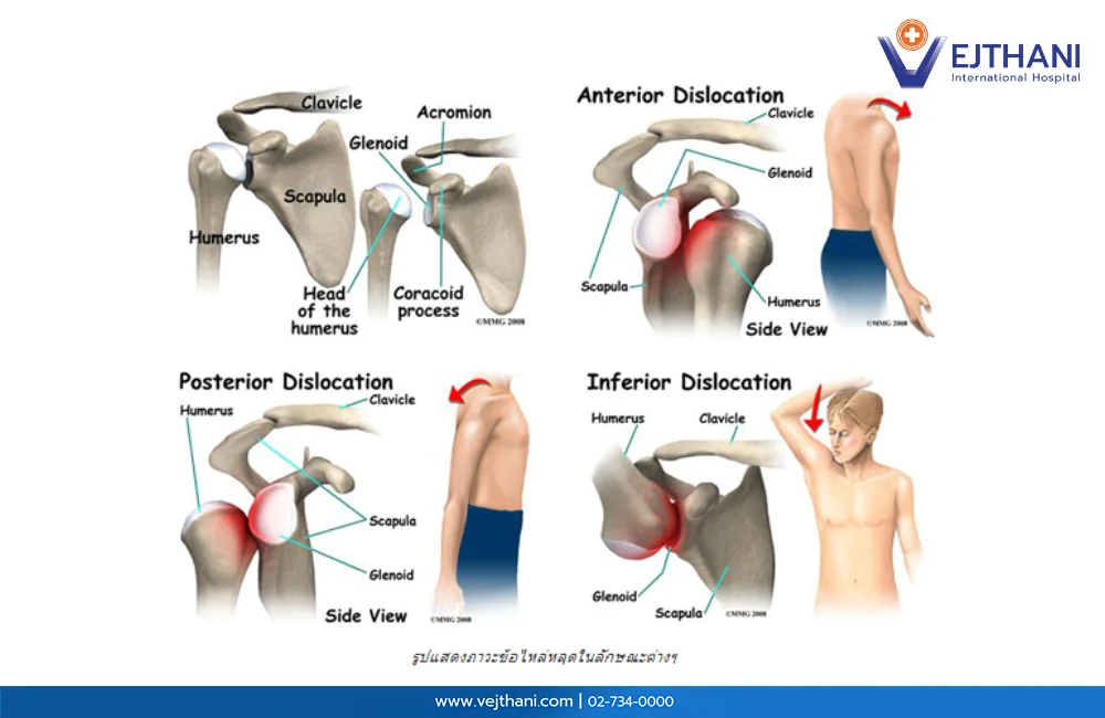 ภาวะข้อไหล่หลุดในลักษณะต่าง ๆ