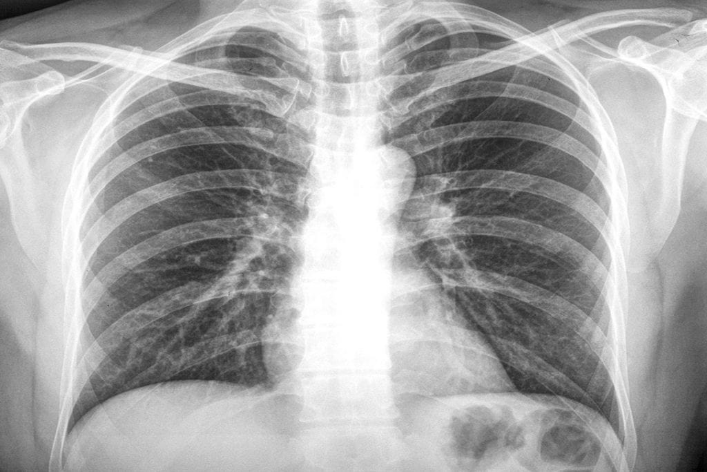 Lung Cancer Can Be Treated Successfully If Found In Early Stage Lung Cancer Can Be Treated Successfully If Found In Early Stage