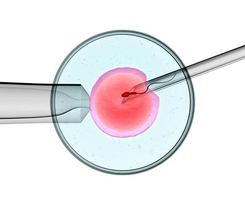 Quy trình sinh con bằng biện pháp ICSI là gì? ICSI (Intra-Cytoplasmic Sperm Injection) là tiêm tinh trùng vào bào tương trứng. Kỹ thuật này 