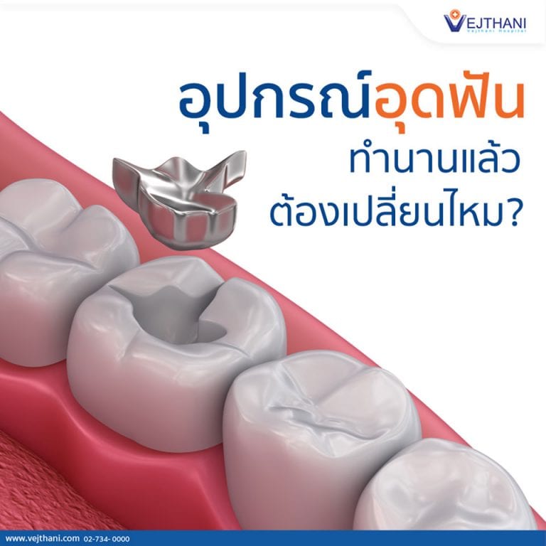 อุปกรณ์อุดฟันใช้ได้นานแค่ไหน