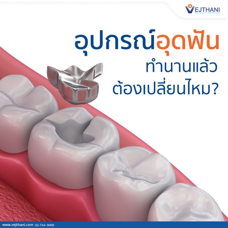 อุปกรณ์อุดฟันใช้ได้นานแค่ไหน