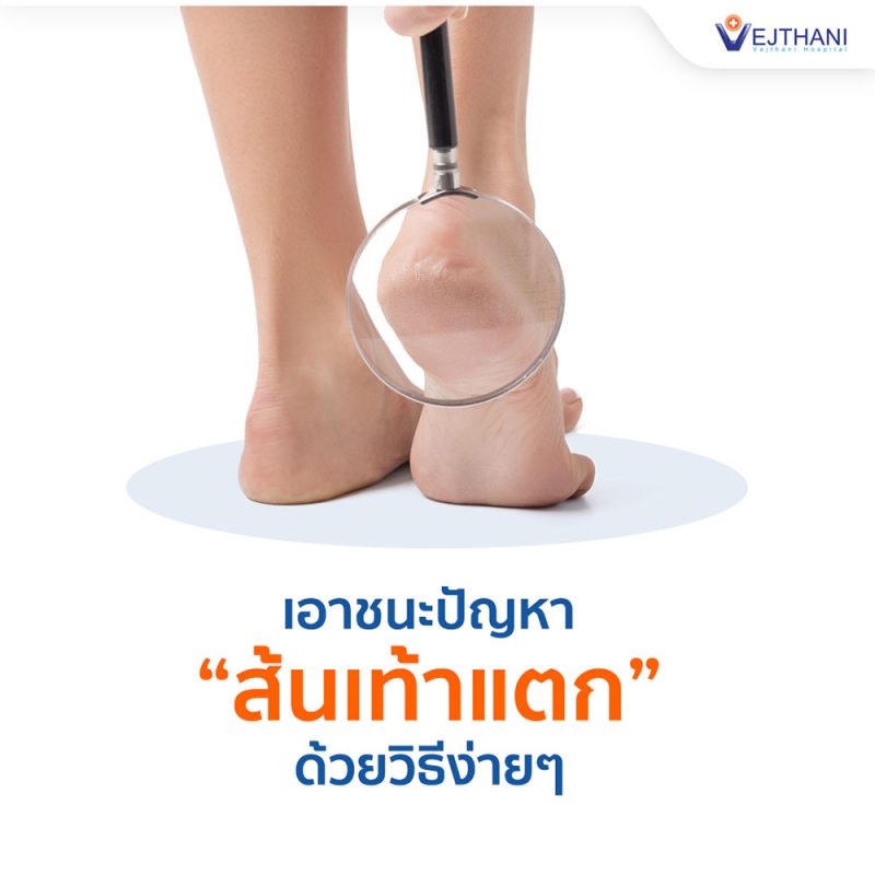 วิธีดูแลปัญหาส้นเท้าแตก