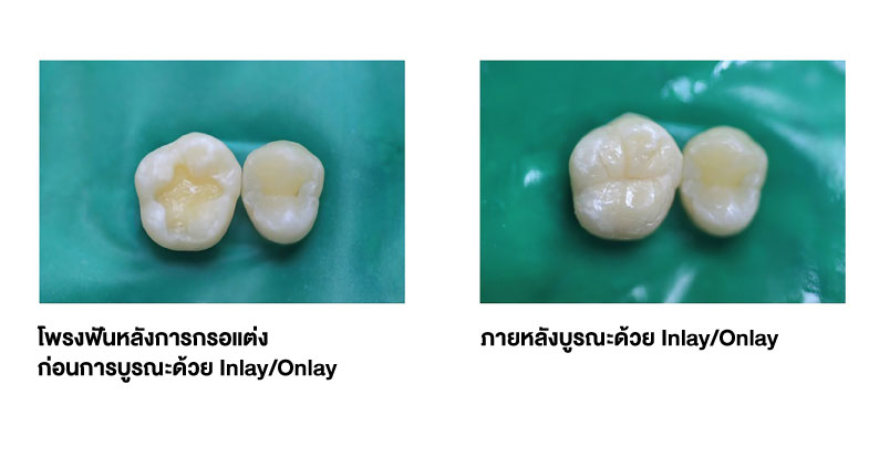 Single-Visit-Ceramic-Inlays-pic3