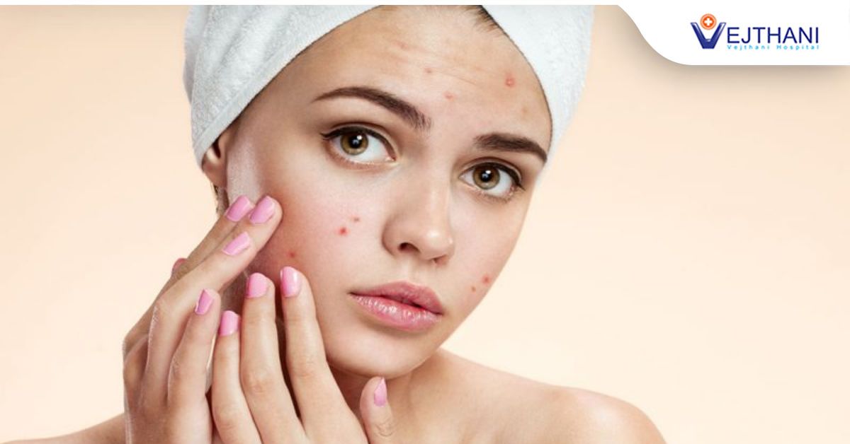 ACNE AND LEAKY GUT SYNDROME