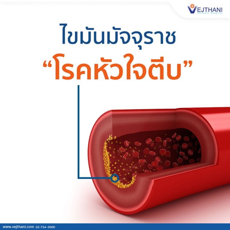เส้นเลือดหัวใจตีบหรือตัน