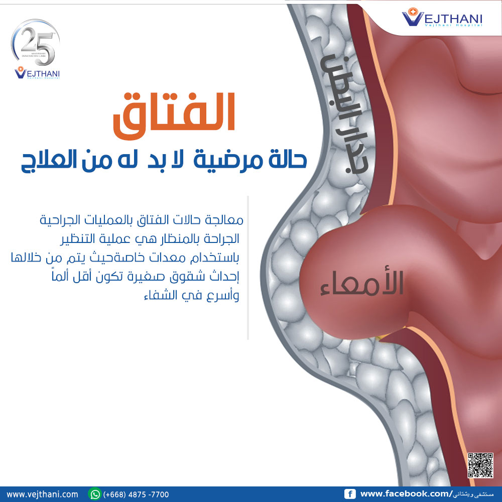 اعراض الفتق البطني