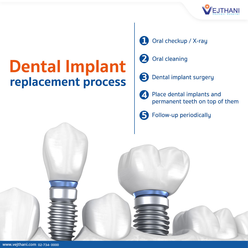 Dental Implant