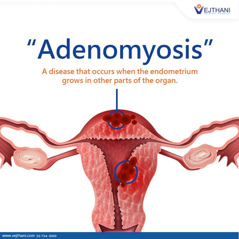 Adenomyosis