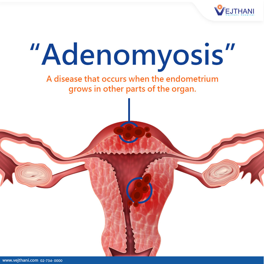 Adenomyosis Treating Adenomyosis