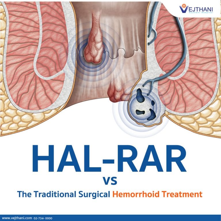 Hemorrhoid