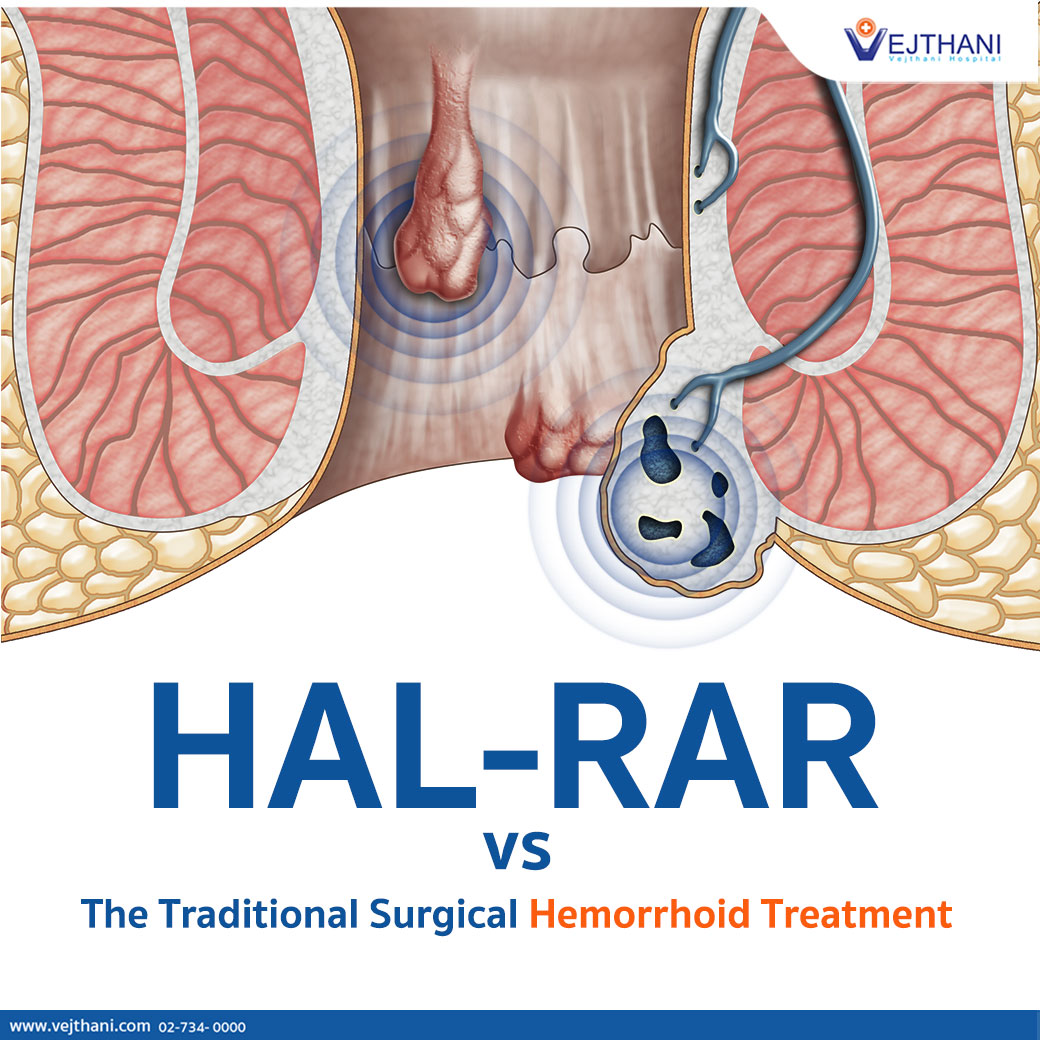 Can we differentiate between symptoms of haemorrhoids (Piles) and  colorectal cancer?