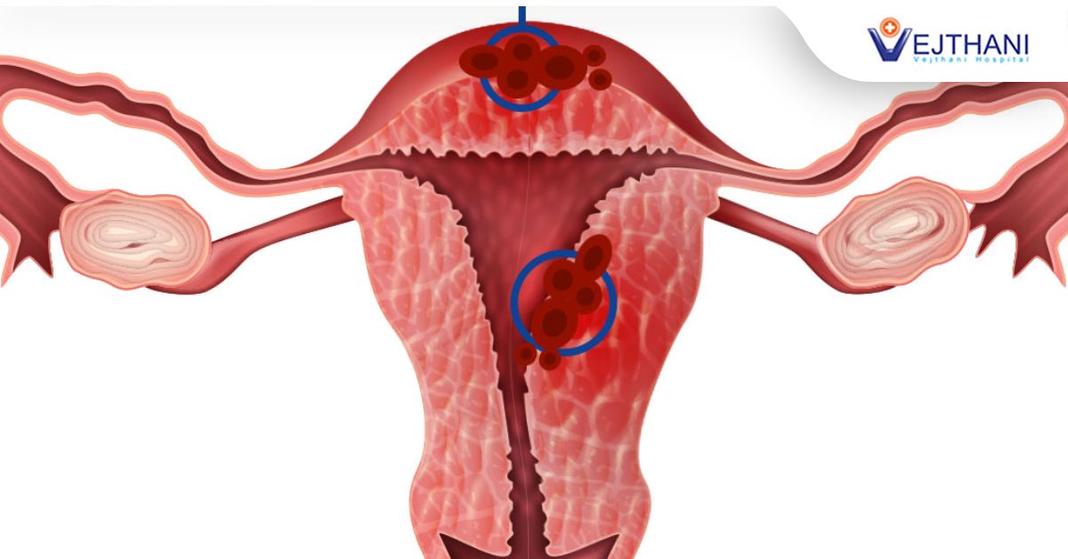 Adenomyosis