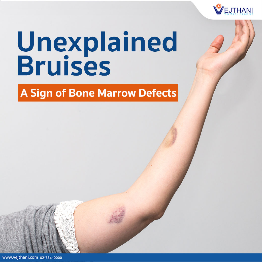 Unexplained Bruises: A Sign of Bone Marrow Defects - Vejthani Hospital