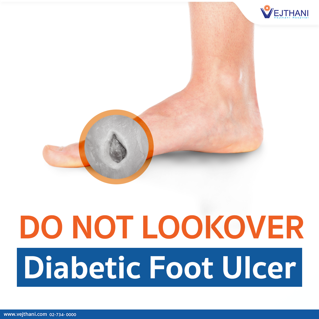 Diabetic Foot Ulcers - Foot & Ankle - Orthobullets