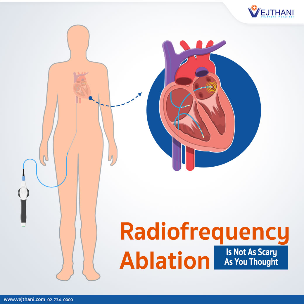 Radiofrequency ablation