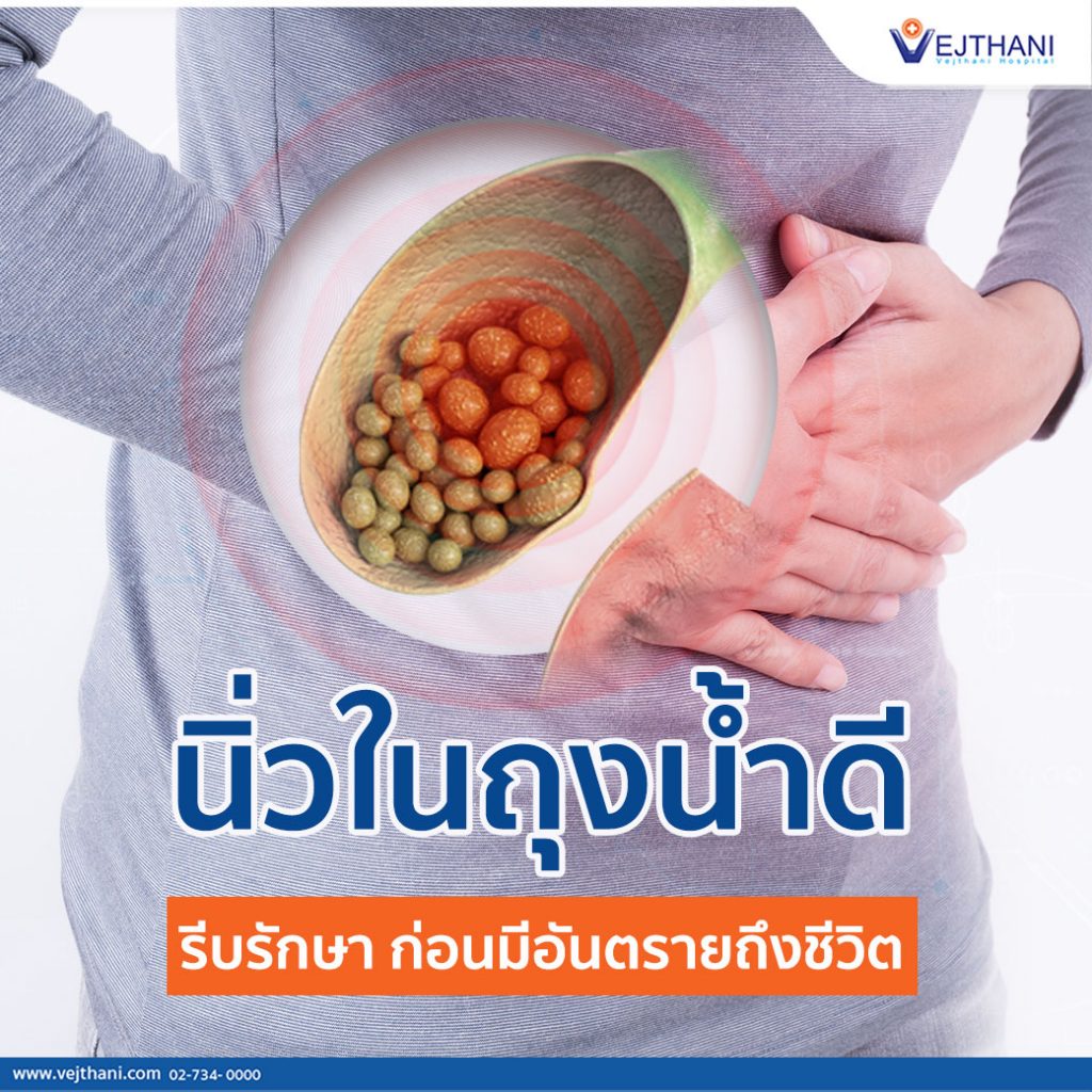 นิ่วในถุงน้ำดี