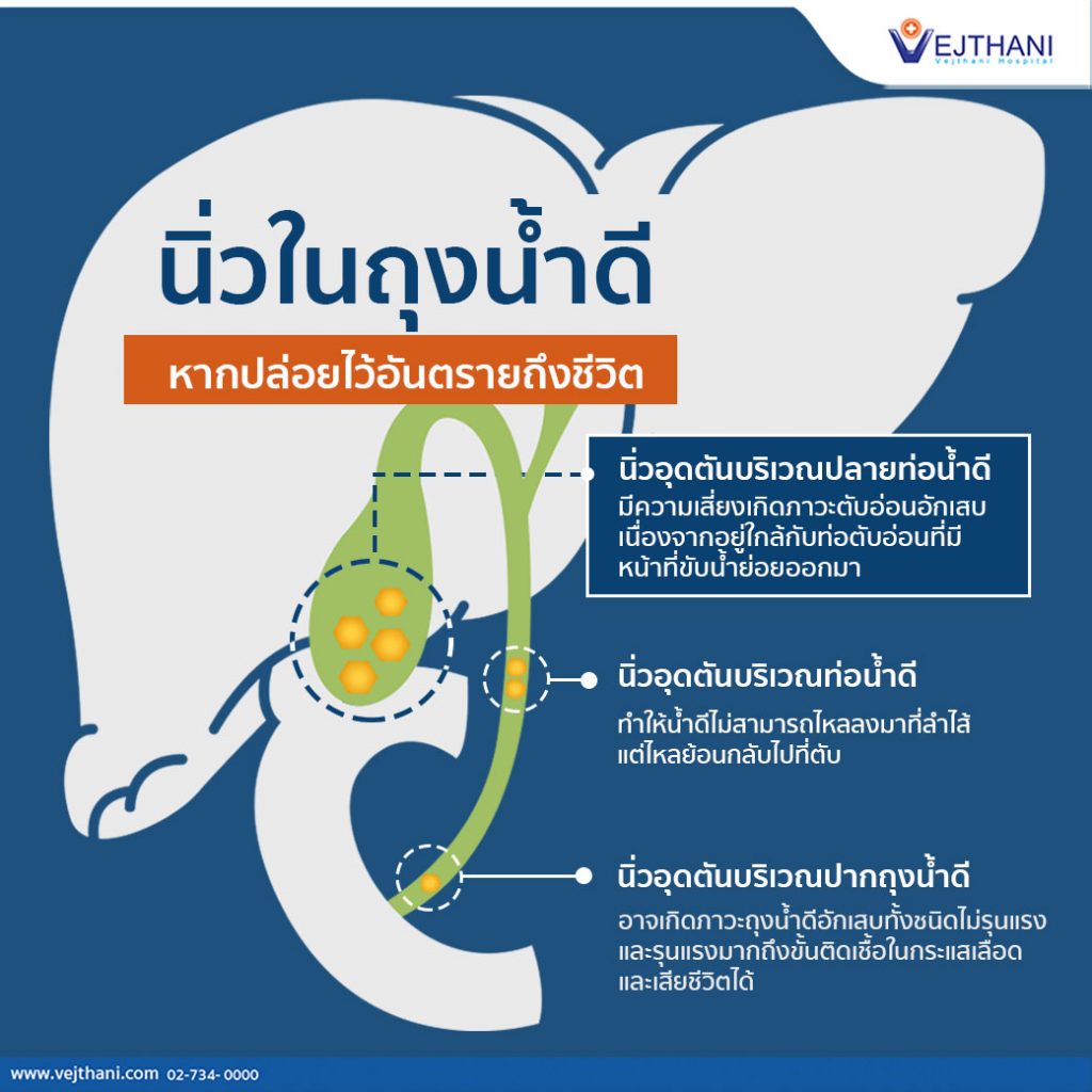 นิ่วในถุงน้ำดี