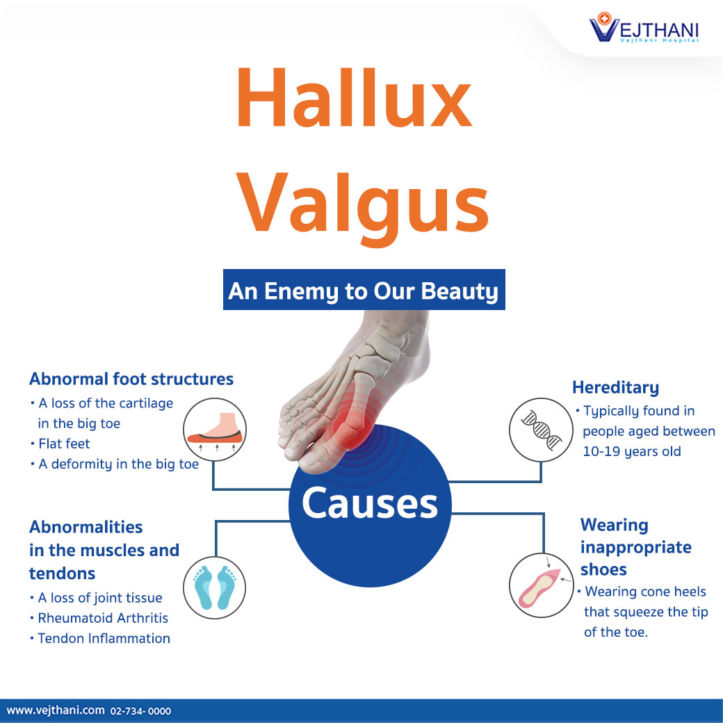 Hallux Valgus