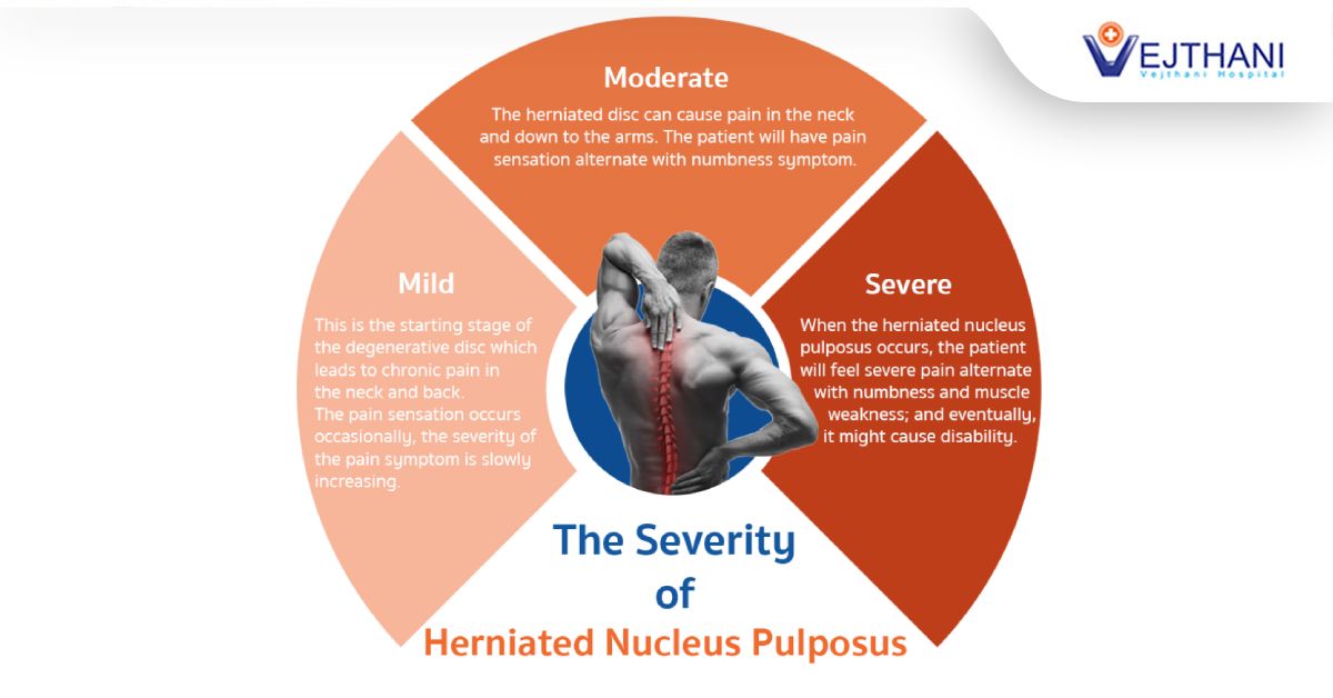 The Severity of Herniated Nucleus Pulposus