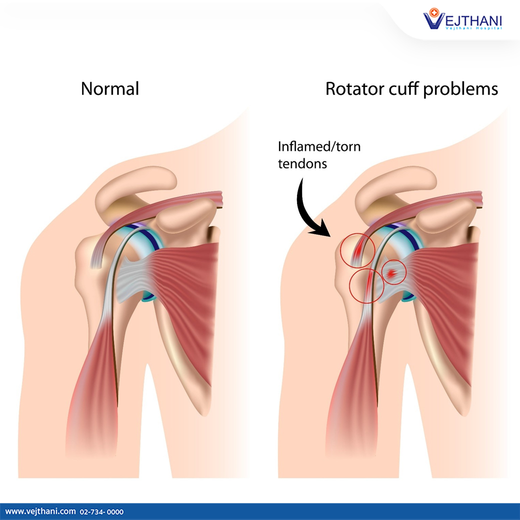 Shoulder Impingement