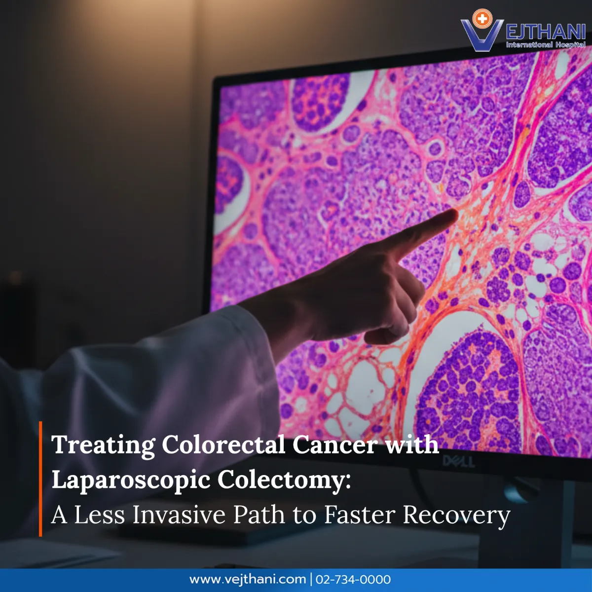 Colorectal cancer diagnosis – doctor pointing at tissue image on screen, showing laparoscopic colectomy treatment at Vejthani International Hospital.