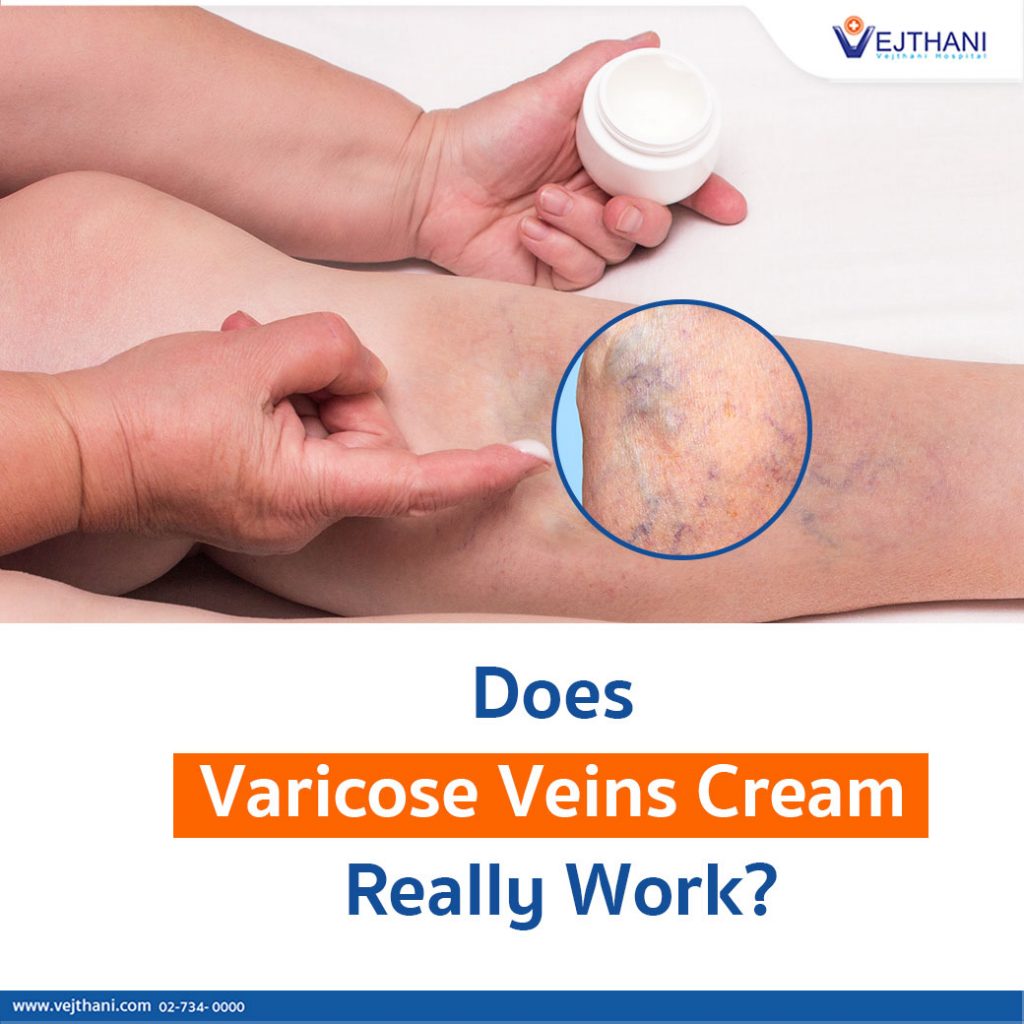 does varicose vein cream work