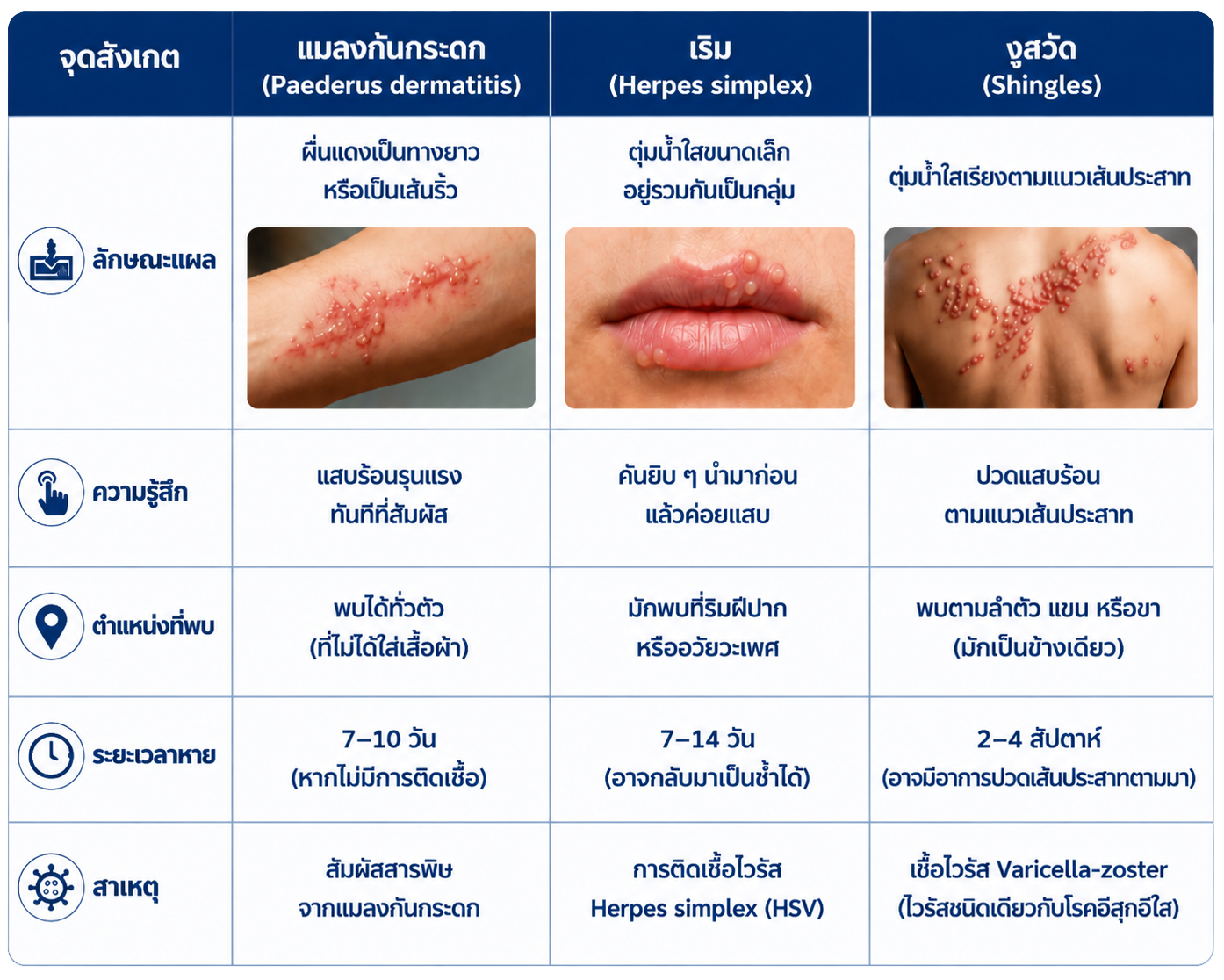 ตารางเปรียบเทียบลักษณะผื่น แมลงก้นกระดก vs เริม vs งูสวัด