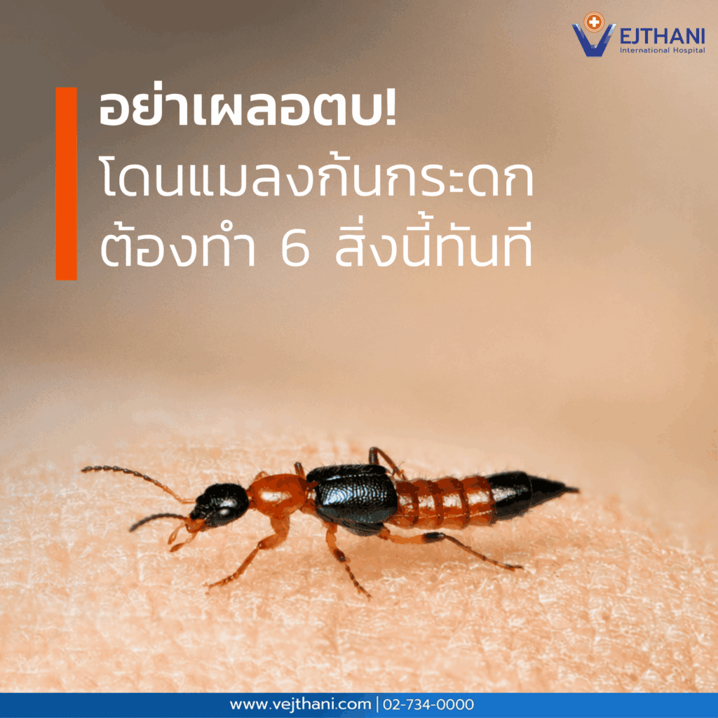 อย่าเผลอตบ! โดนแมลงก้นกระดกต้องทำ 6 สิ่งนี้ทันที