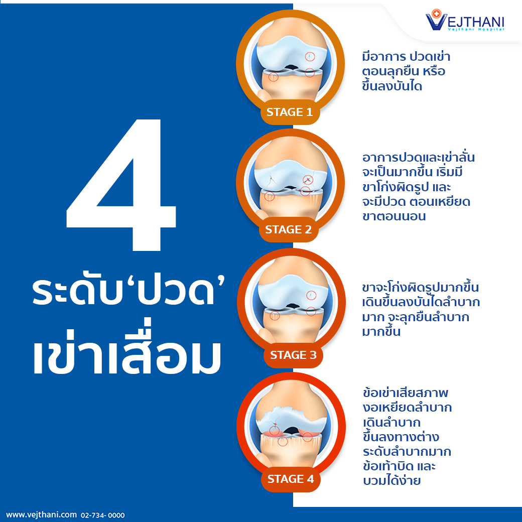 4 ระดับอาการ 'ปวด' จากเข่าเสื่อม - โรงพยาบาลเวชธานี 4 ระดับอาการ 'ปวด' จากเข่าเสื่อม - โรงพยาบาลเวชธานี