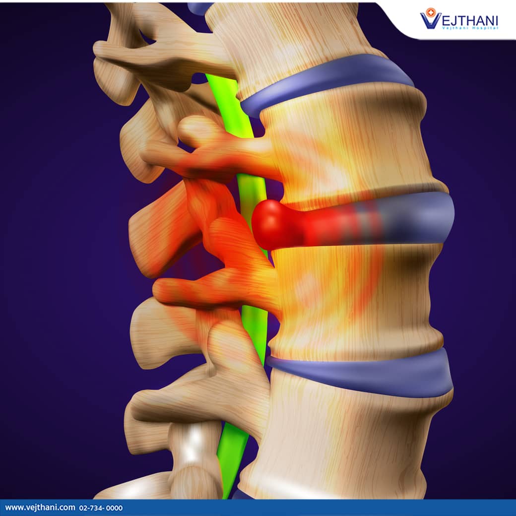 Đến bệnh viện Vejthani để điều trị thoát vị đĩa đệm
