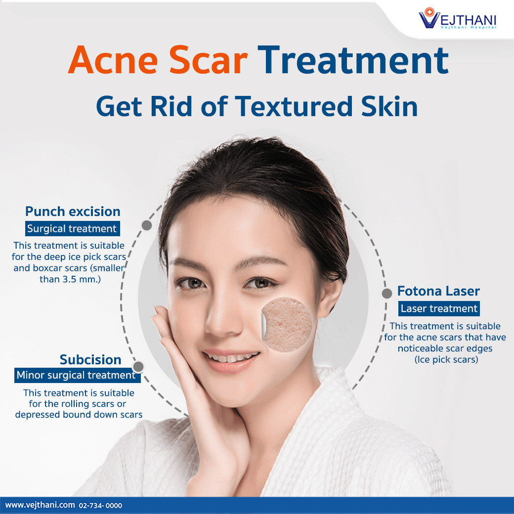 Acne Scar Treatment Los Angeles, Beverly Hills, Larchmont | lupon.gov.ph