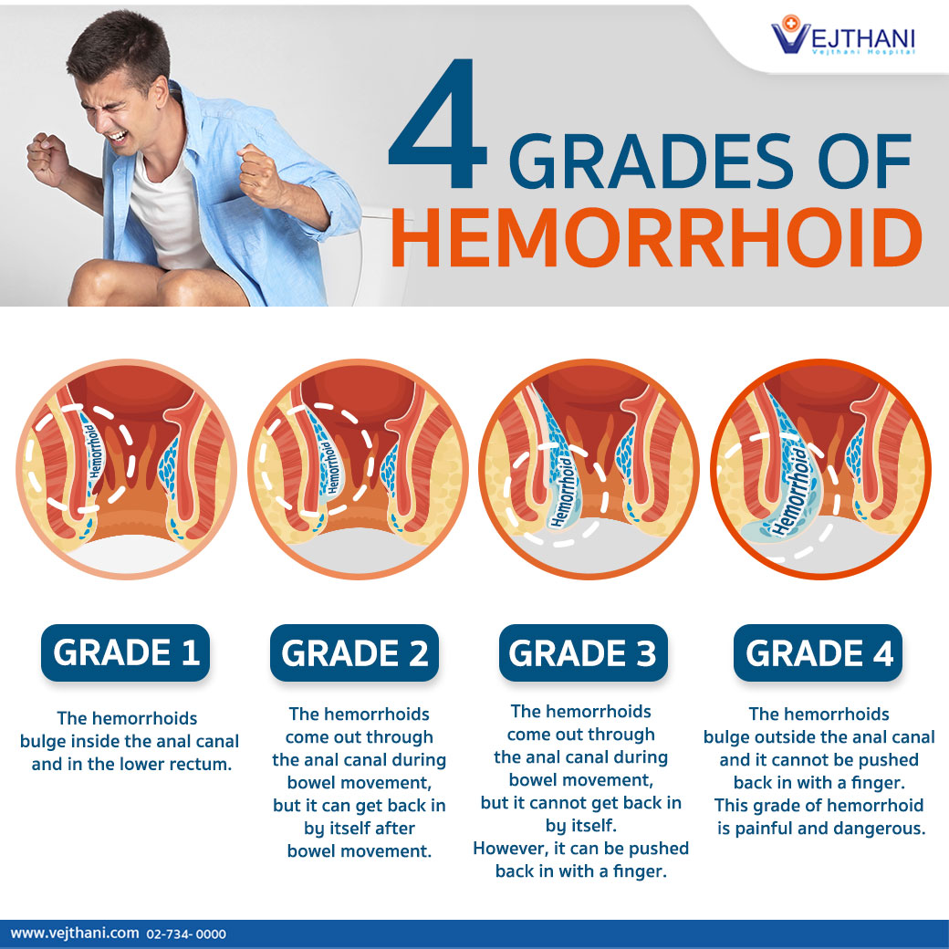 what are the symptoms of hemorrhoids