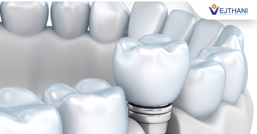 สร้างชิ้นงาน CERAMIC INLAY/ONLAY ด้วยเทคโนโลยี CAD/CAM