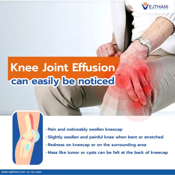 Symptoms of Knee Joint Effusion can easily be noticed