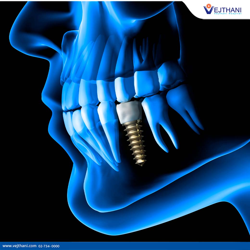 Contact Vejthani Hospital for Dental Implants in Thailand