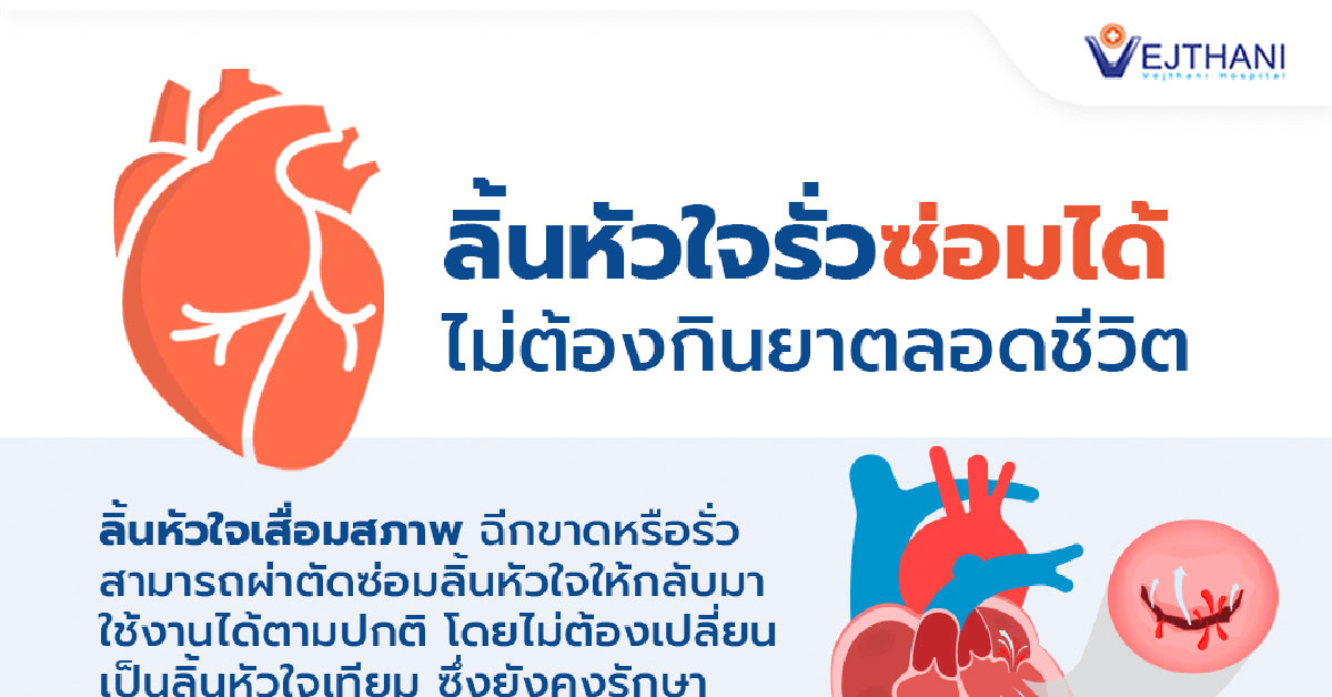 ซ่อมลิ้นหัวใจ