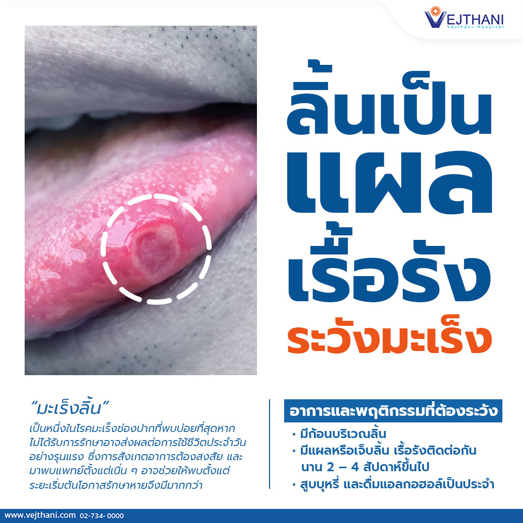 ลิ้นเป็นแผล อาจเป็นสัญญาณเตือนโรคมะเร็งลิ้น - Vejthani Hospital ลิ้นเป็นแผล อาจเป็นสัญญาณเตือนโรคมะเร็งลิ้น - Vejthani Hospital