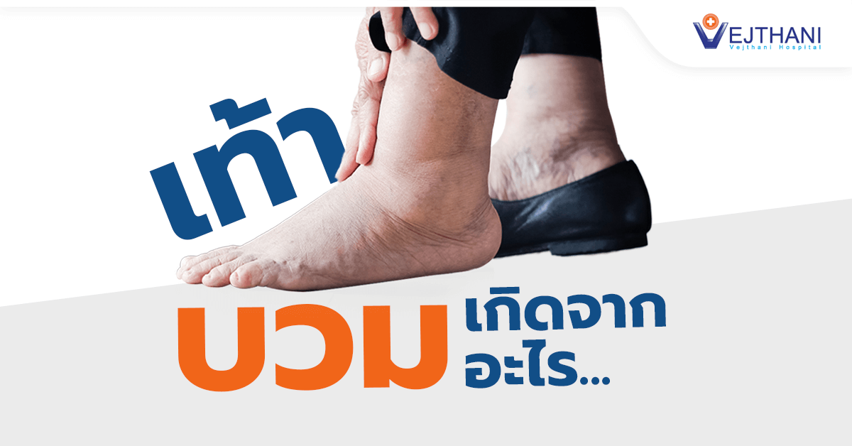 เท้าบวม เกิดจากอะไร - Vejthani Hospital เท้าบวม เกิดจากอะไร - Vejthani Hospital