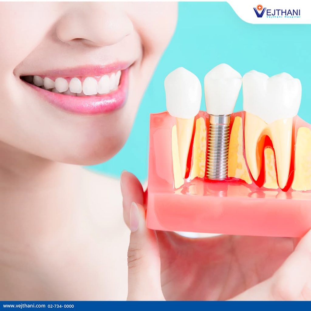 Smiling woman holds up a model of a dental implant in Thailand. dental implant in Thailand.