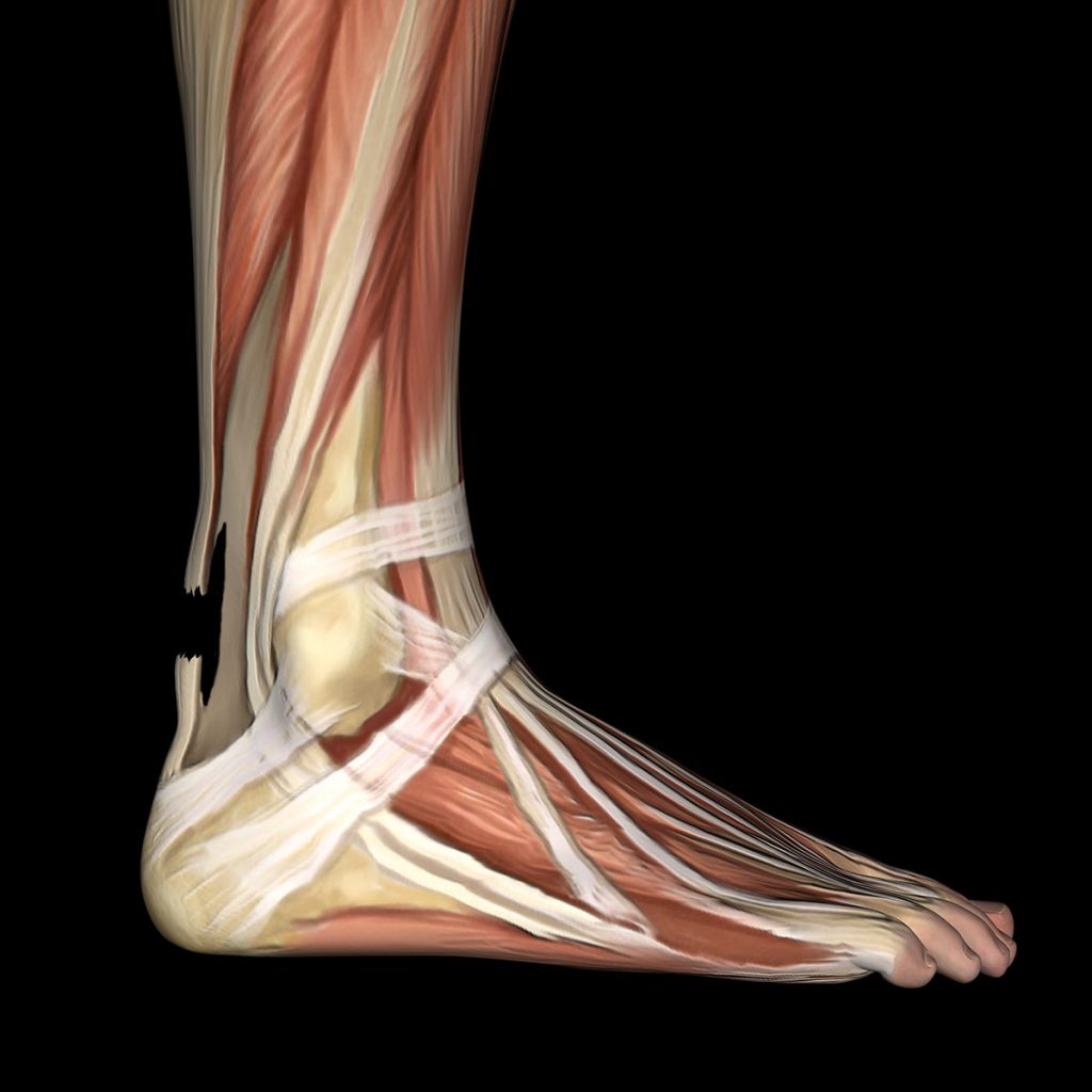 Achilles-tendon-rupture