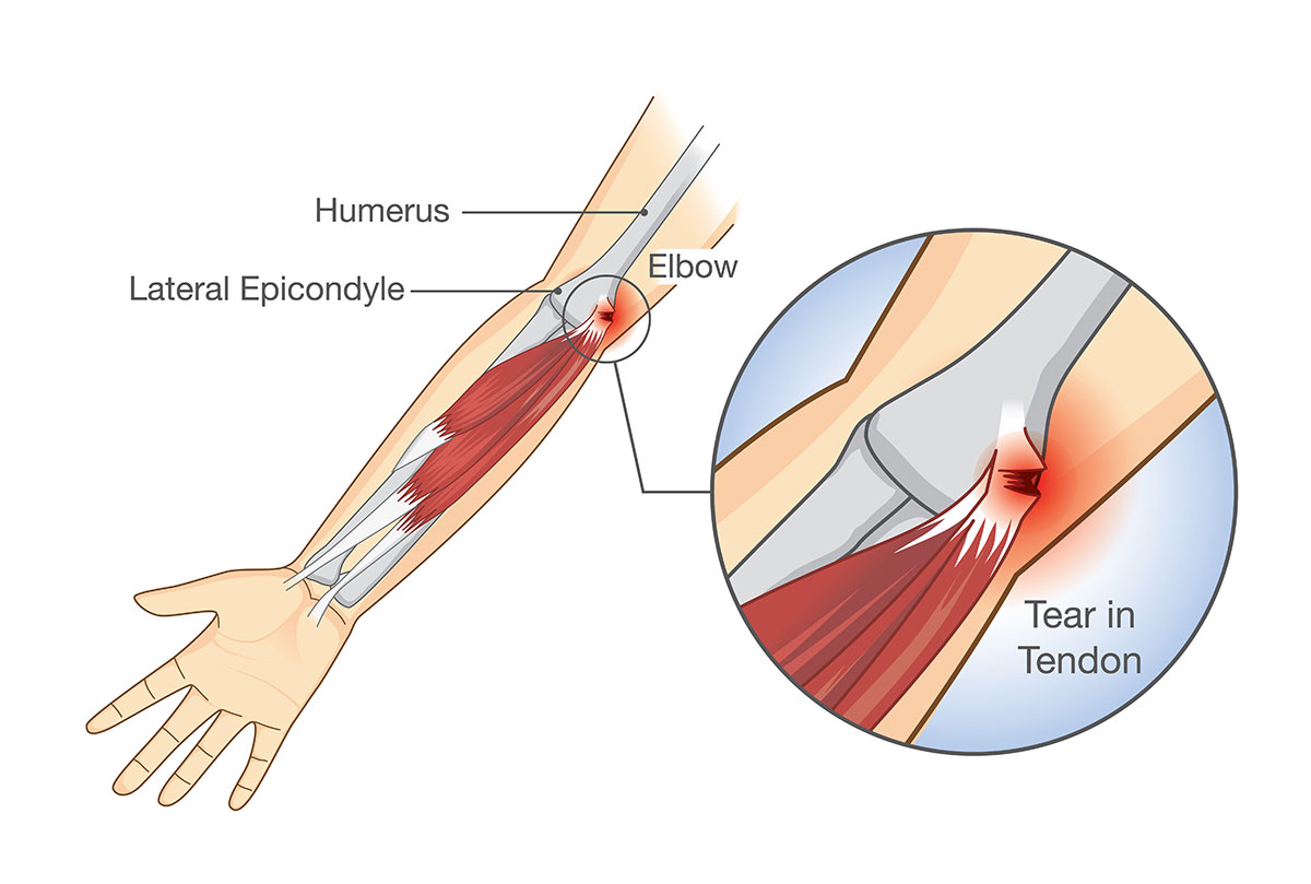 Golfer’s elbow