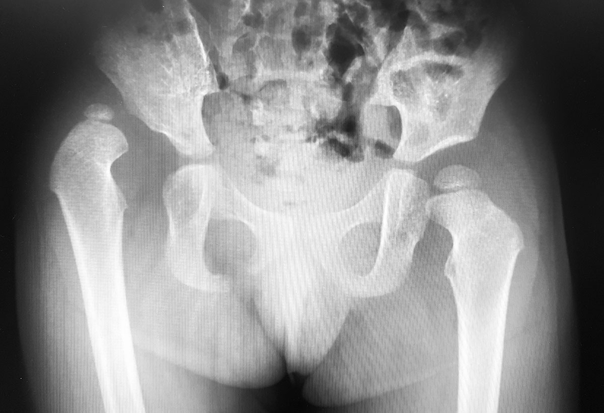 hip dysplasia)