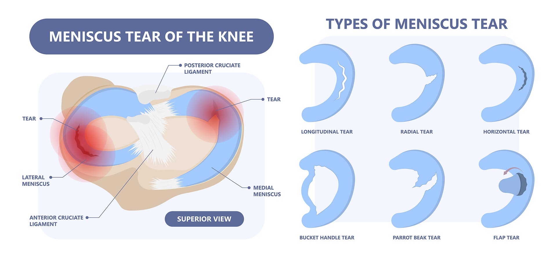 Signs Of A Torn Meniscus Offers, Save 55% | jlcatj.gob.mx