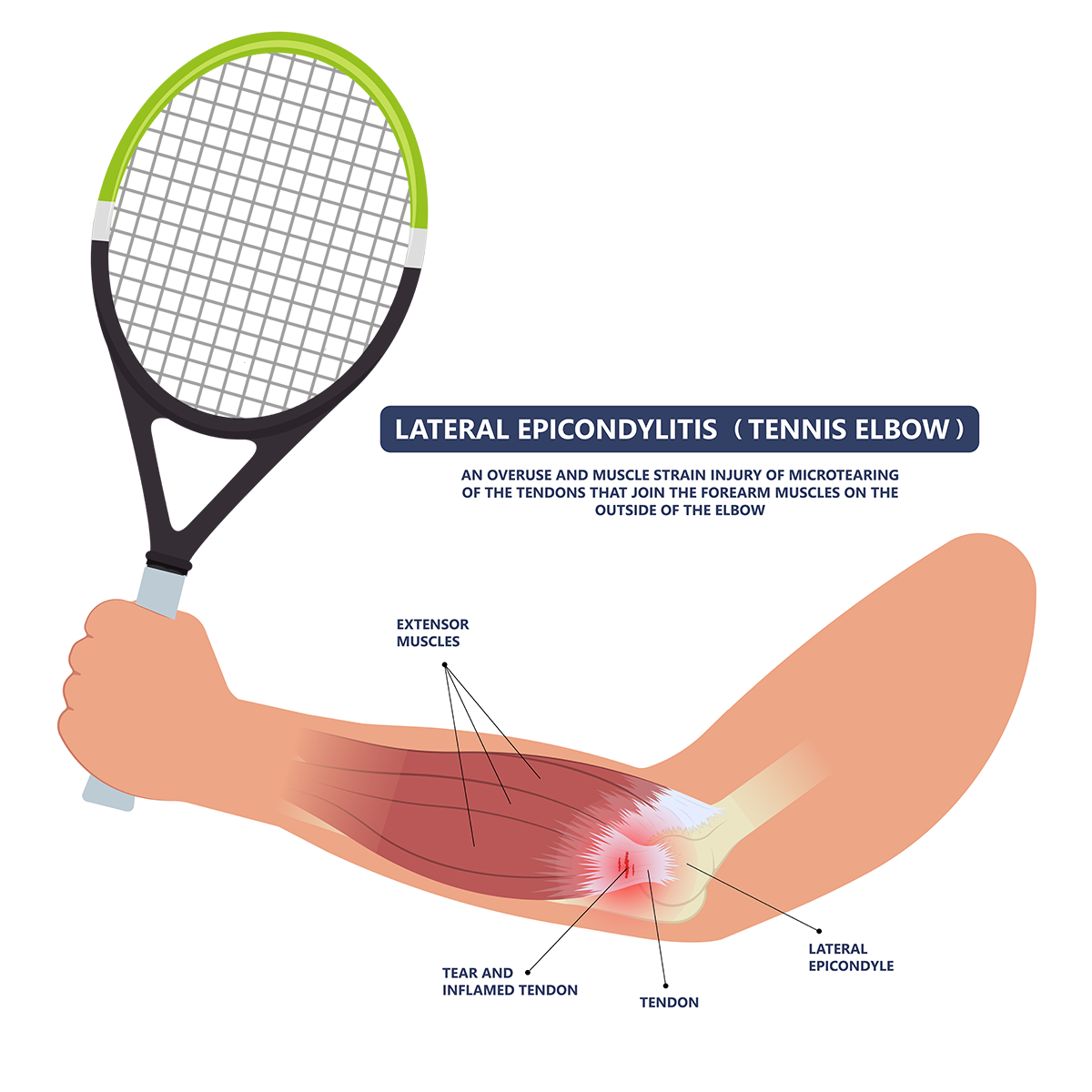 Tennis Elbow 1 