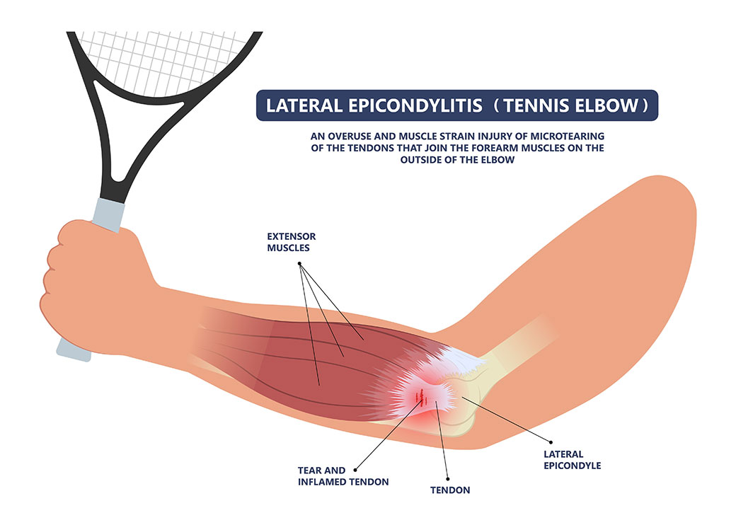 Tennis Elbow Lateral Epicondylitis Symptoms And Causes