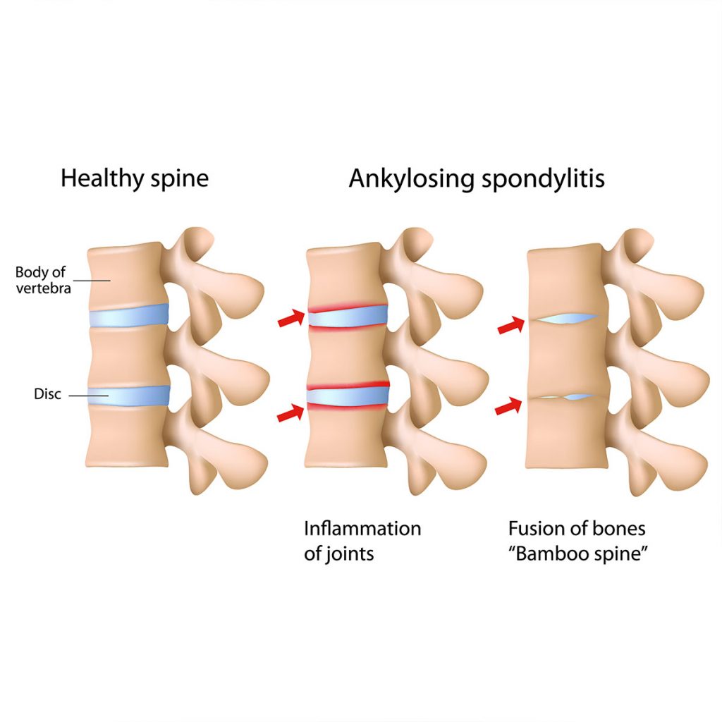 Ankylosing Spondylitis
