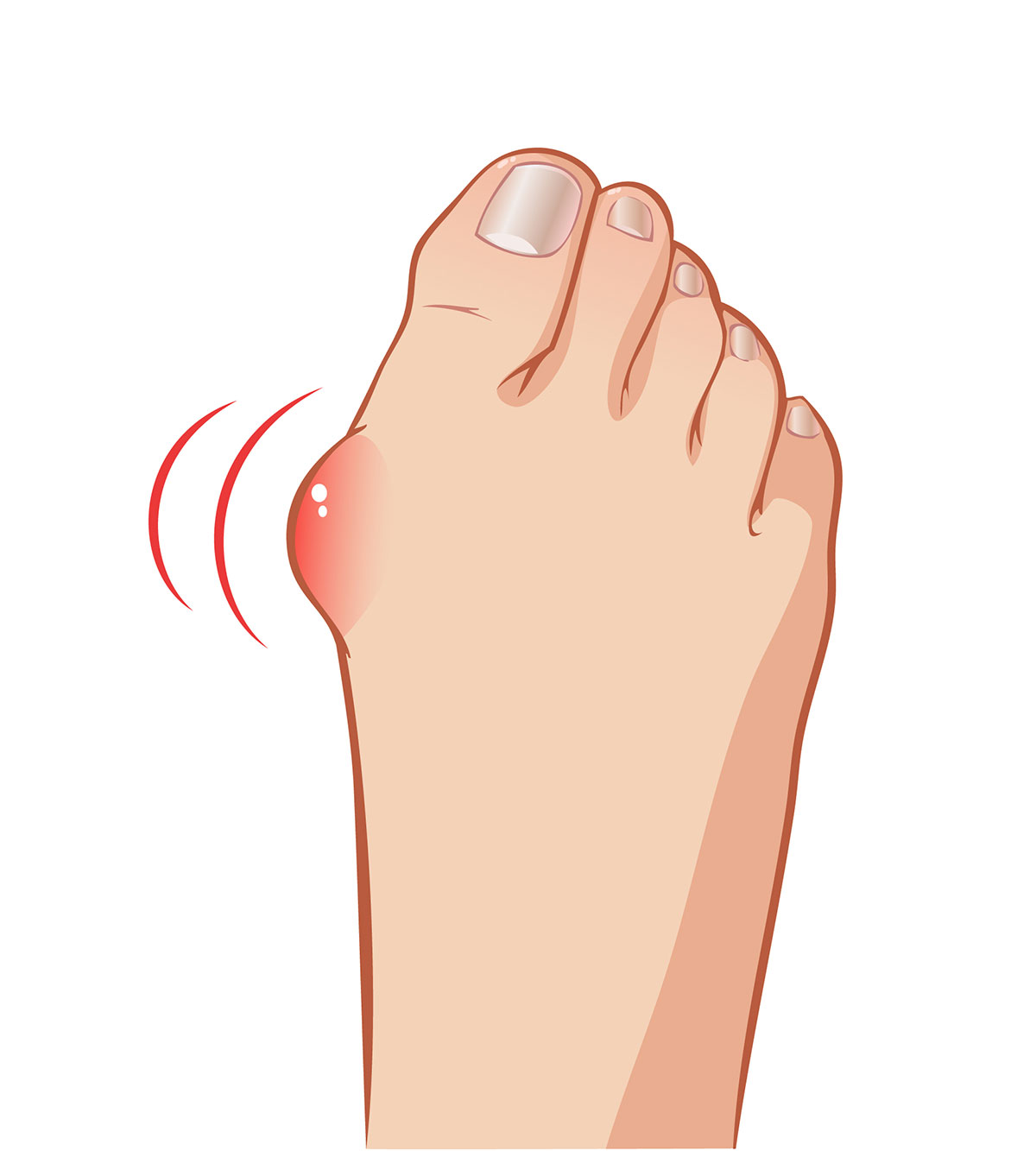 Top 3 Causes and Treatments for Bunions Vejthani
