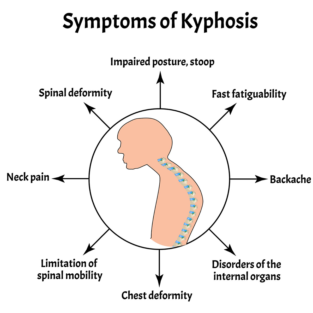 Problems associated with Kyphosis.