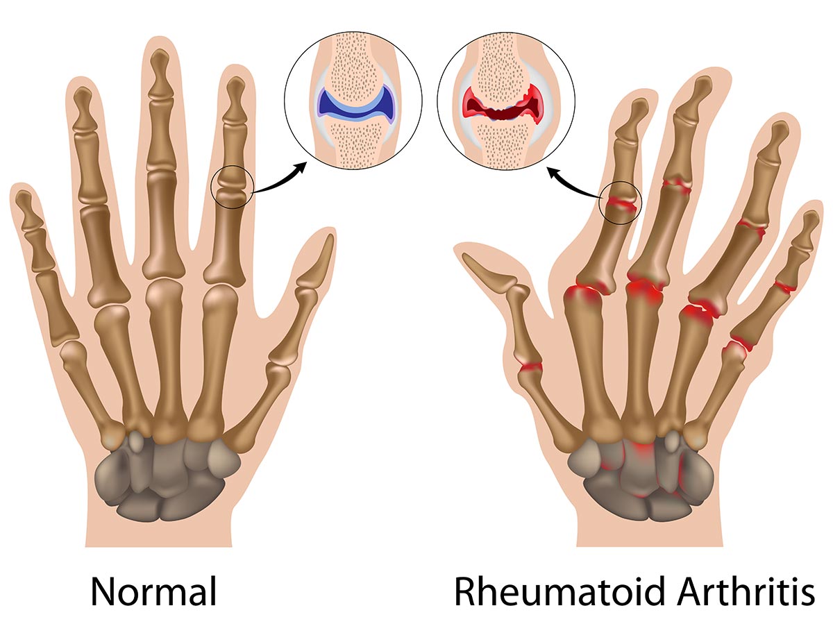 Rheumatoid arthritis